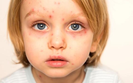 Brennkopper (impetigo) Brennkopper (impetigo)