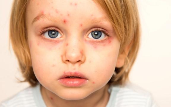 Brennkopper (impetigo)