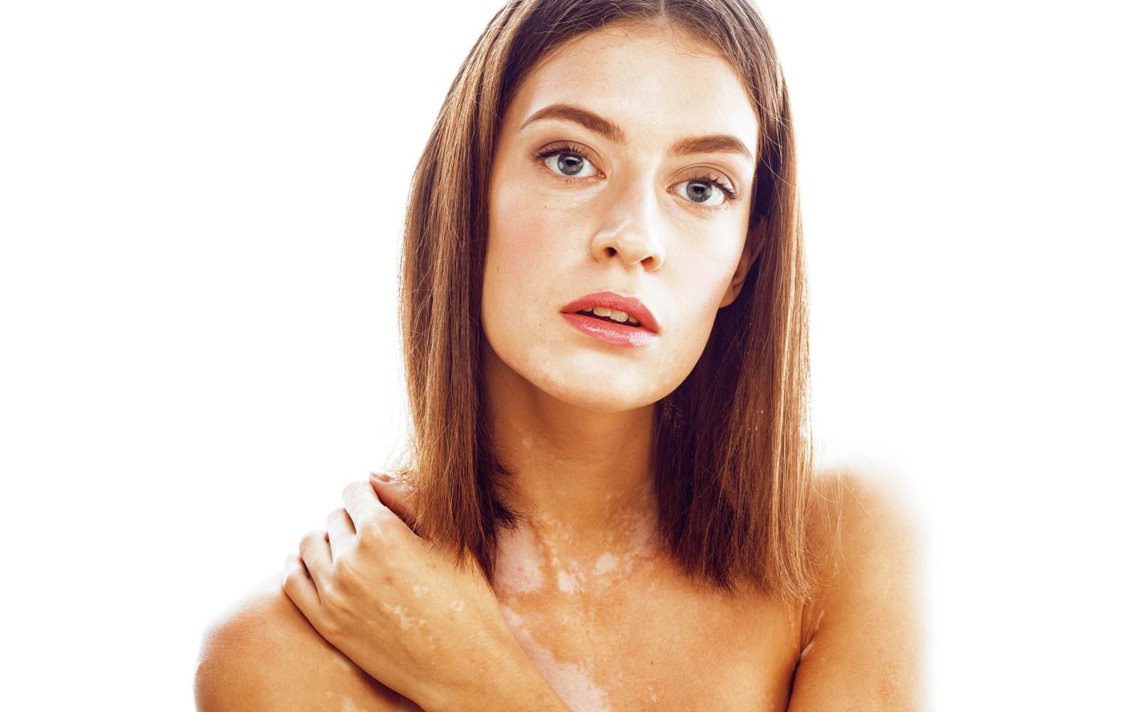 Ung kvinne som holder en hånd over skulderen, hvor hun har synlige lyse hudområder som er typisk for vitiligo.