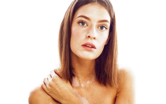 Vitiligo Vitiligo