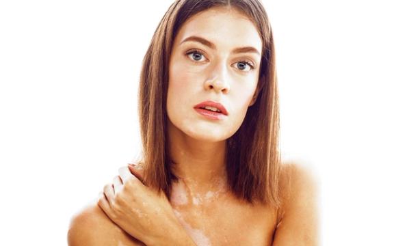 Vitiligo