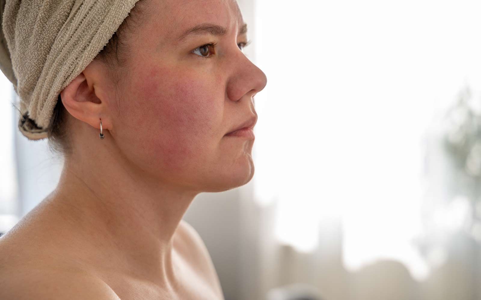 Ung kvinne med håndkle rundt håret vises fra siden. Hun har hudrødme i kinnene. Rosacea kan gi vedvarende rødhet i pannen, kinn, på nesen og haken.