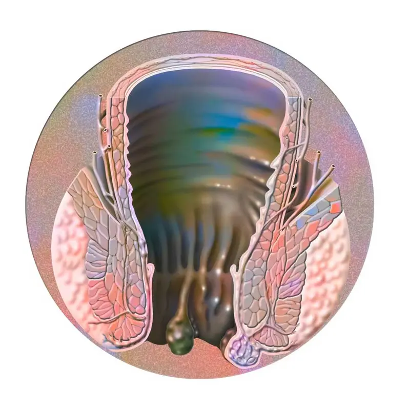 Illustrasjon av utvendig hemoroide