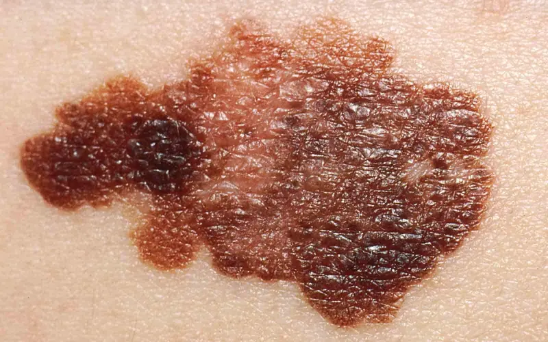 Asymmetrisk føflekk med ujevn farge og mørkere partier