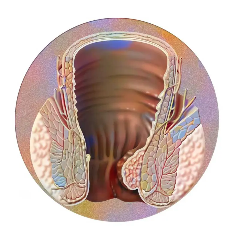 Illustrasjon innvendig hemoroide