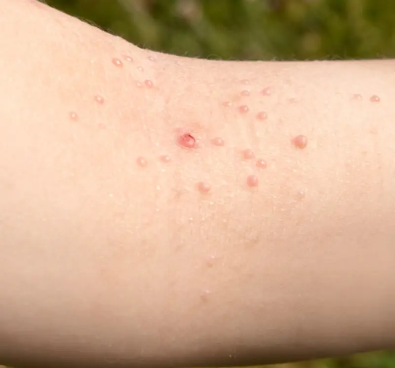 Mollusker på innsiden av albuen