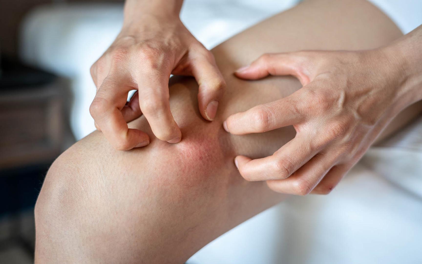 En person klør seg så kraftig på låret, huden er rød og irritert