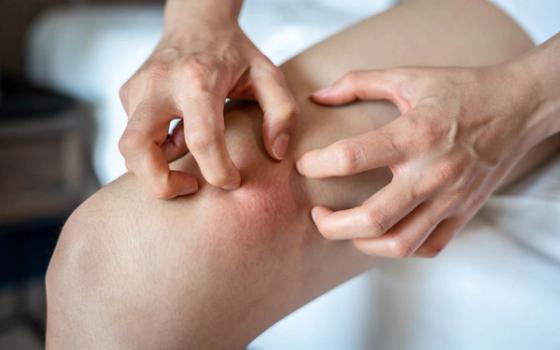 Kløe i huden Kløe i huden