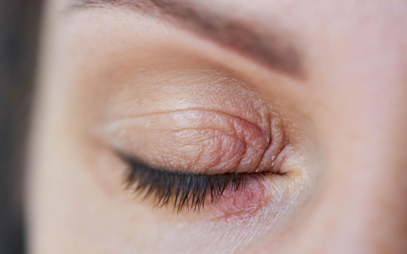 Lukket øyelokk med rødt, flassende eksem