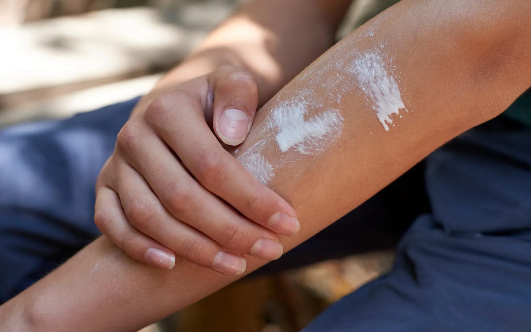 En arm blir smurt inn med solkrem