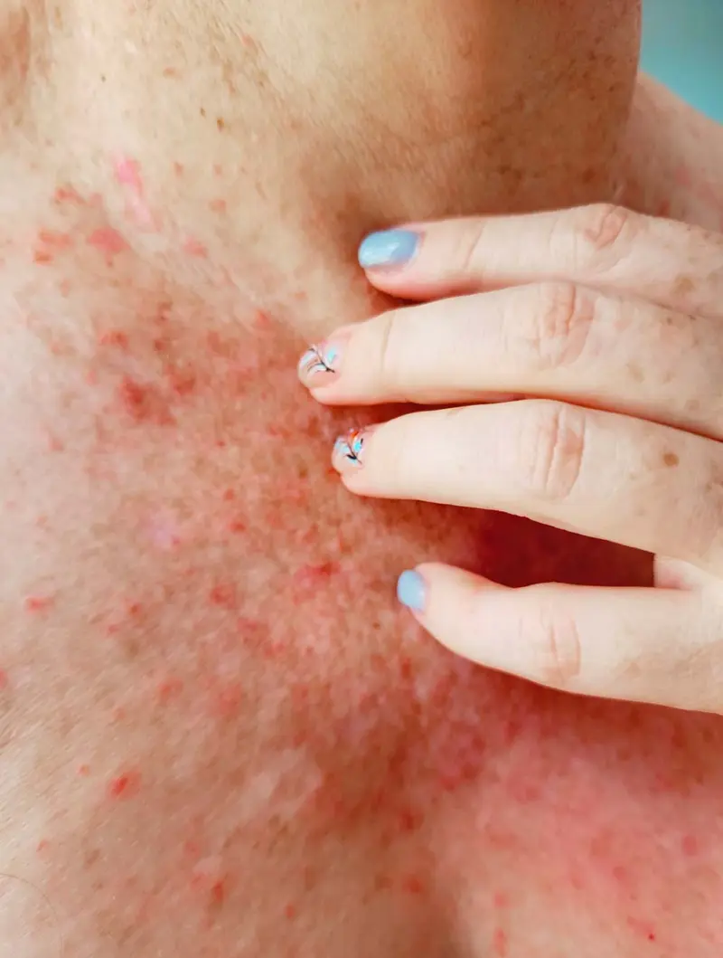 Soleksem på hals og bryst