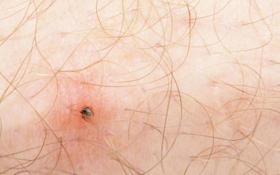 Borreliose | Symptomer og behandling Borreliose | Symptomer og behandling