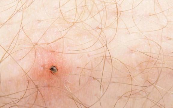 Borreliose | Symptomer og behandling