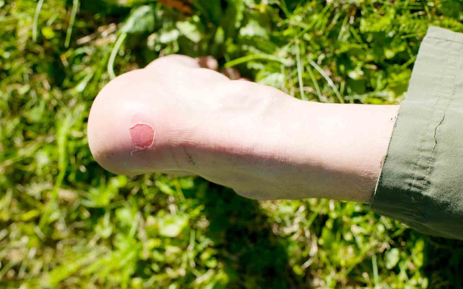 Bar fot i gresset med gnagsår på hælen