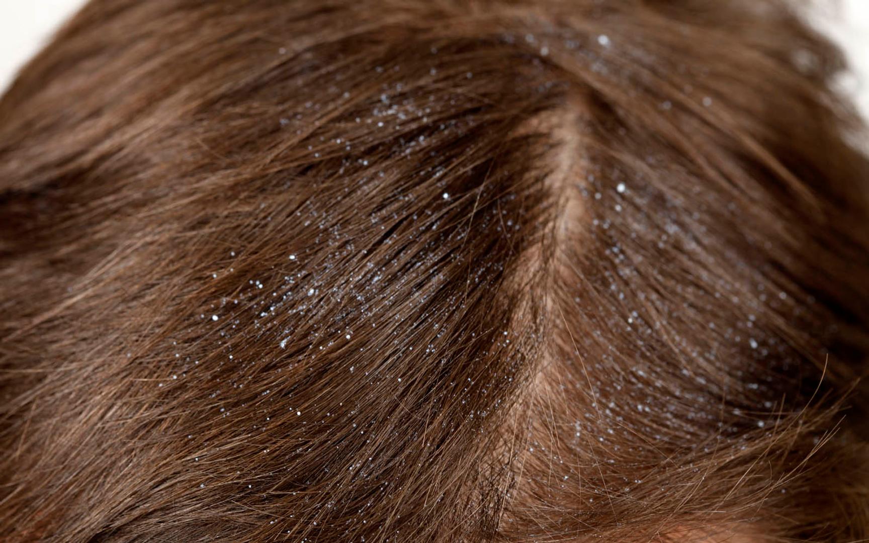 Nærbilde av hår og hodebunn. Tørt, finkornet flass synes tydelig mot det brune håret.