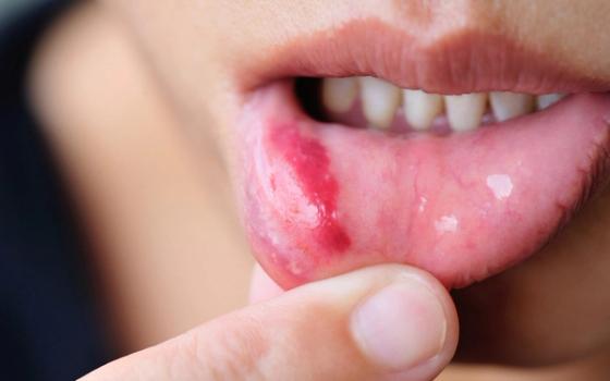 Munnskold (after) Munnskold (after)