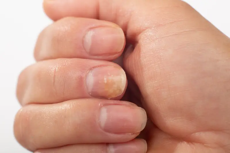 Neglesopp på fingernegler