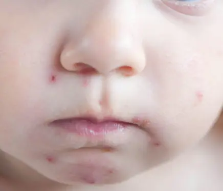 Vannkopper rundt munnen til et lite barn