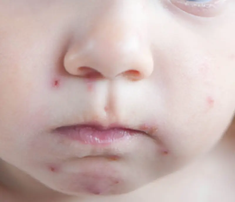Vannkopper rundt munnen til et lite barn