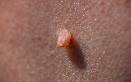 Skin tag (hudtagger) Skin tag (hudtagger)