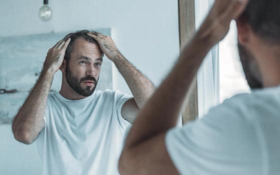 Tynnere i håret? Tynnere i håret?