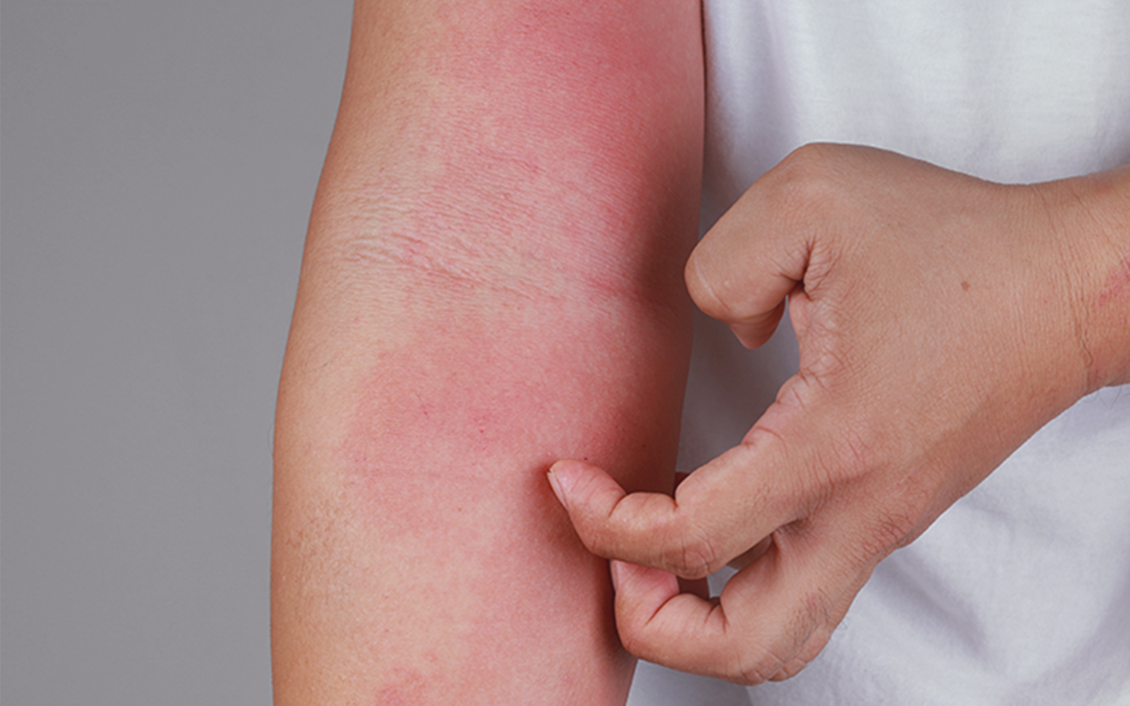 Person klør på rødt, irritert utslett på innsiden av albuen