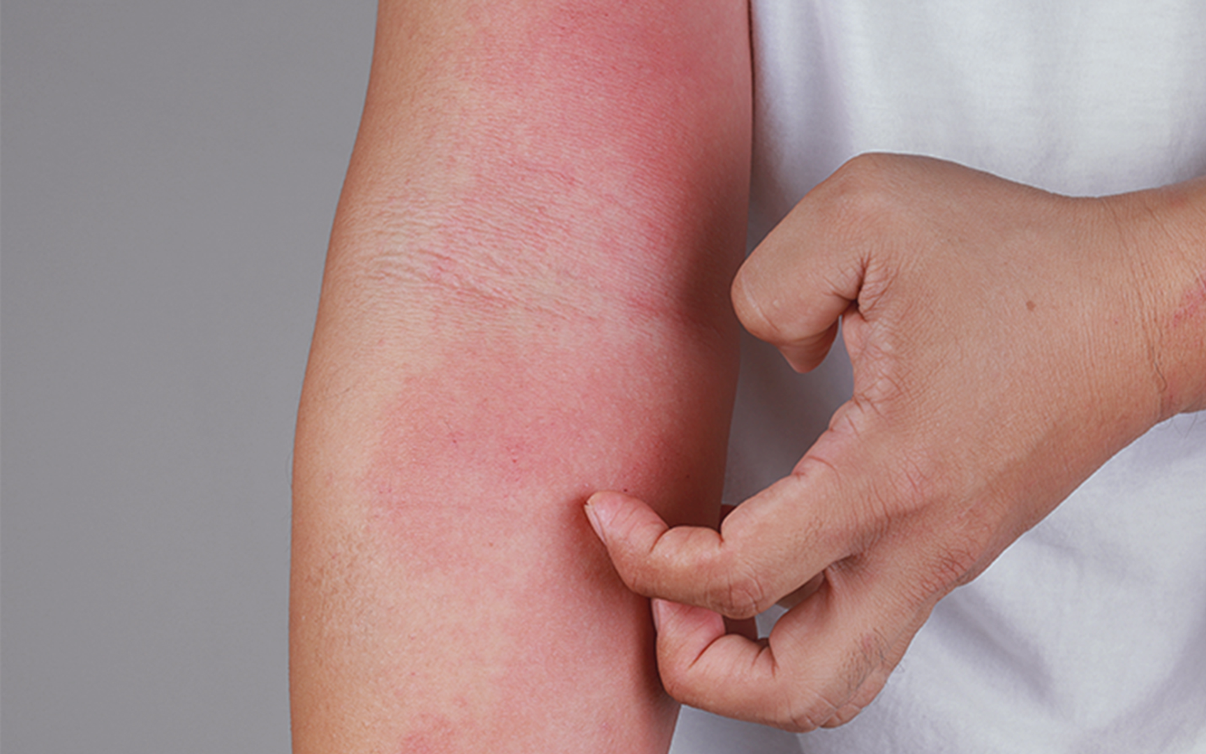 Person klør på rødt, irritert utslett på innsiden av albuen
