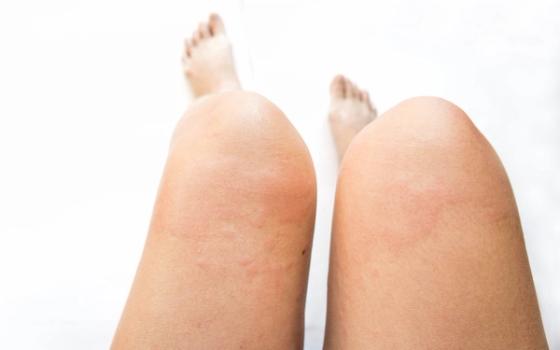 Lichen planus Lichen planus