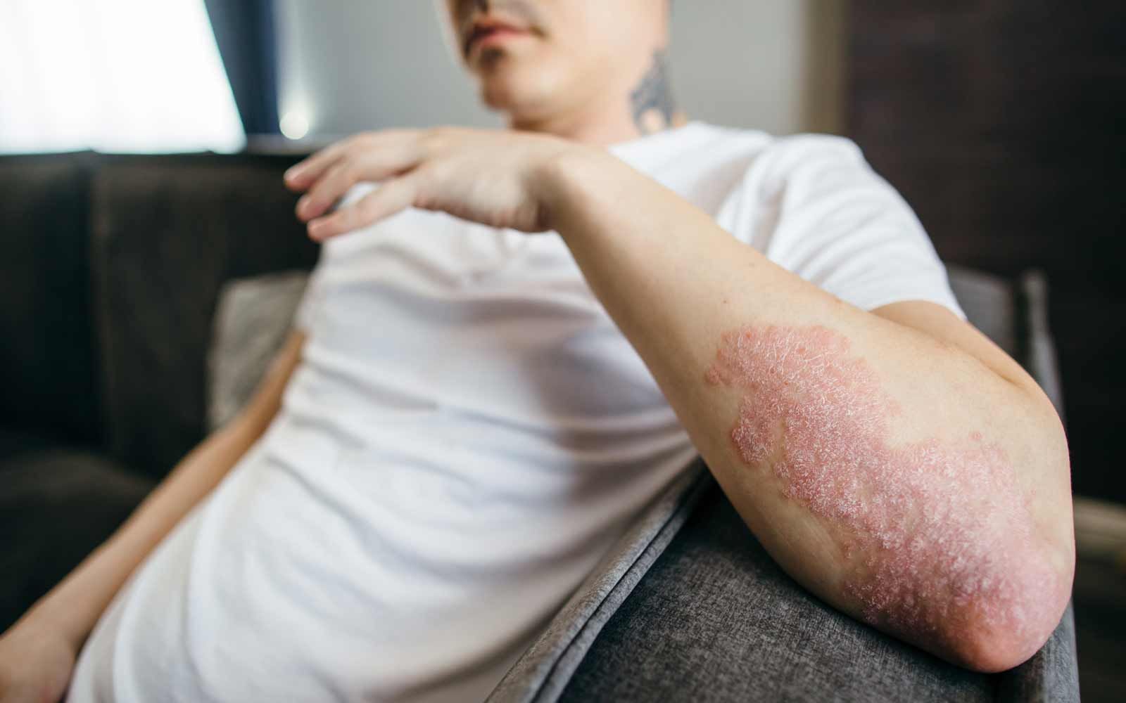 Mann med psoriasis på albuen