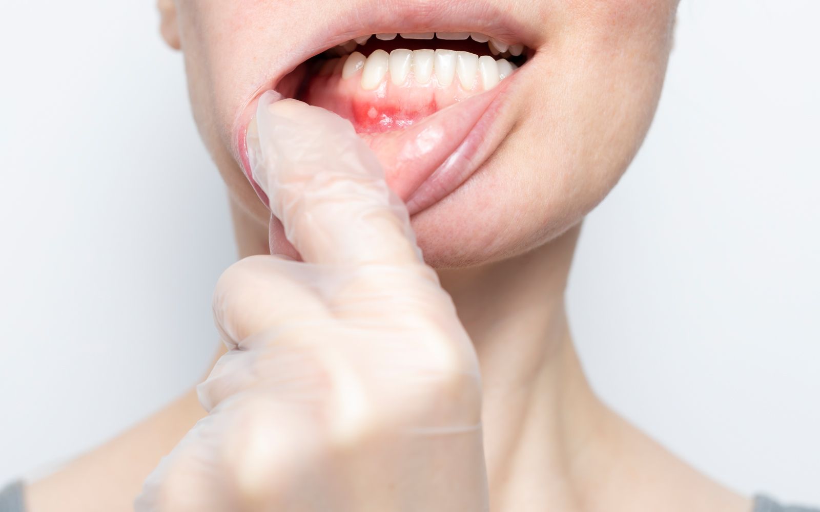 En kvinne med engangshansker i plast på hendene, drar munnviken til side for å vise tannkjøttet i underkjeven. Hun viser et rødt sår med en gulaktig blemme i.