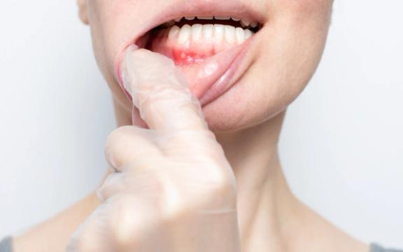 Sår og blemmer i munnen