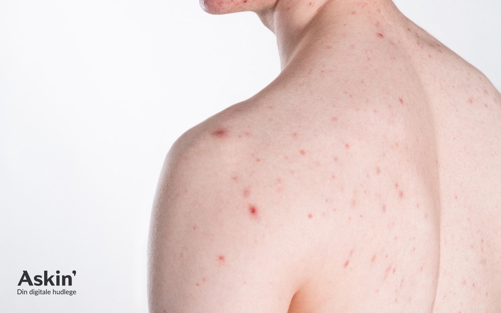 En person har røde kviser, prikker og betente områder på rygg og skuldre.