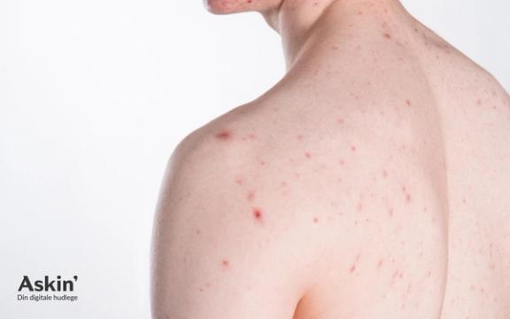 Behandling av akne hos hudlegen