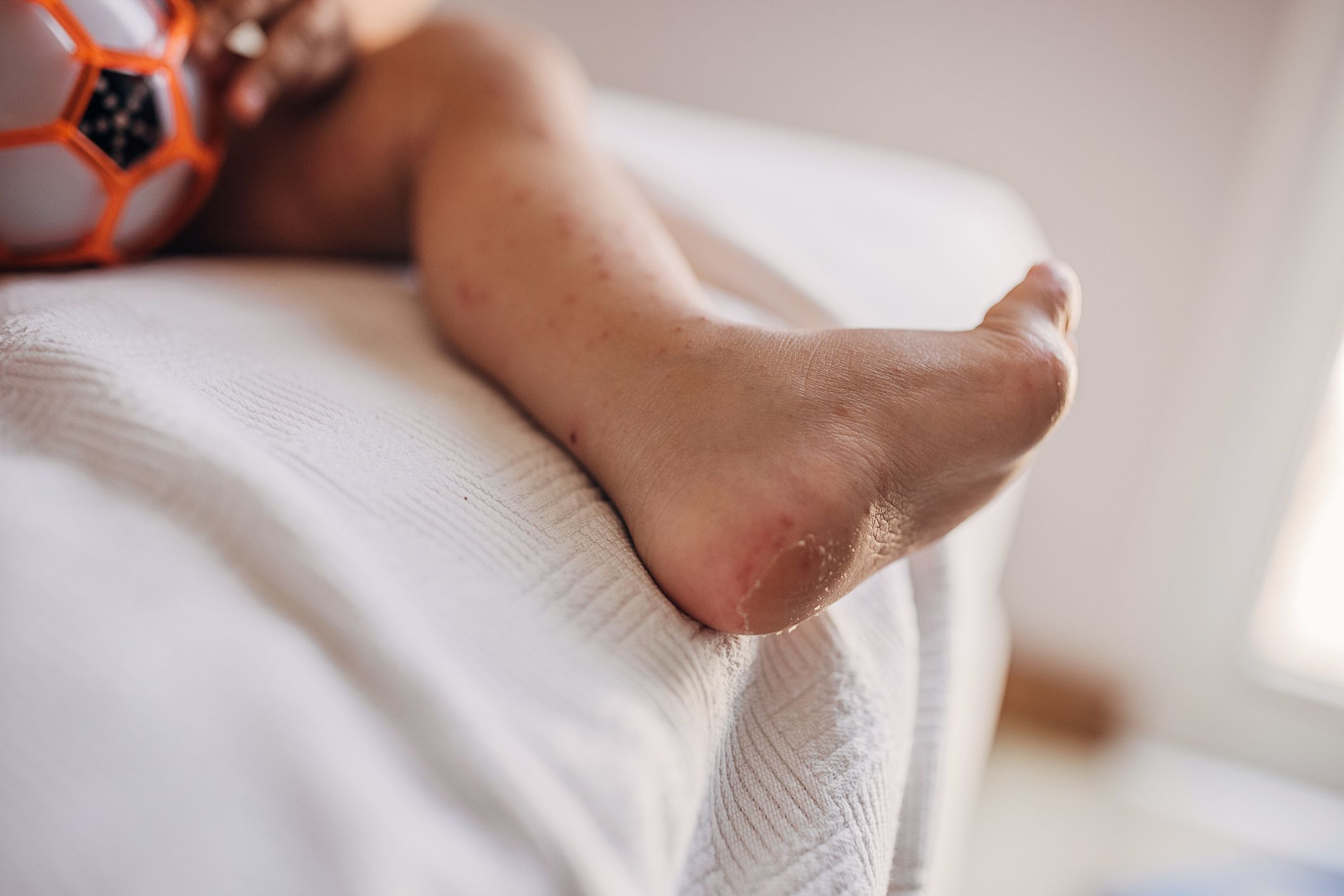 Liten gutt med utslett under fotsålen