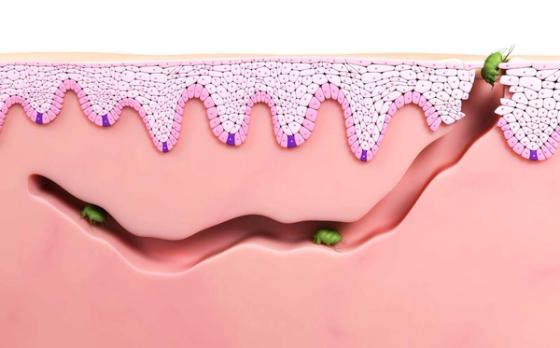 Hva er skabb? Hva er skabb?