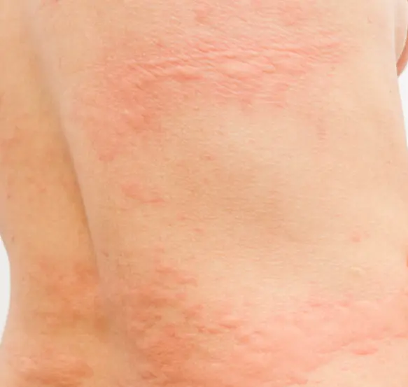 Elveblest utslett på ryggen