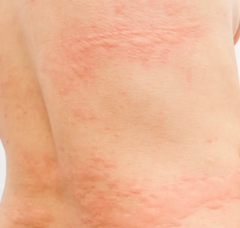 Elveblest utslett på ryggen