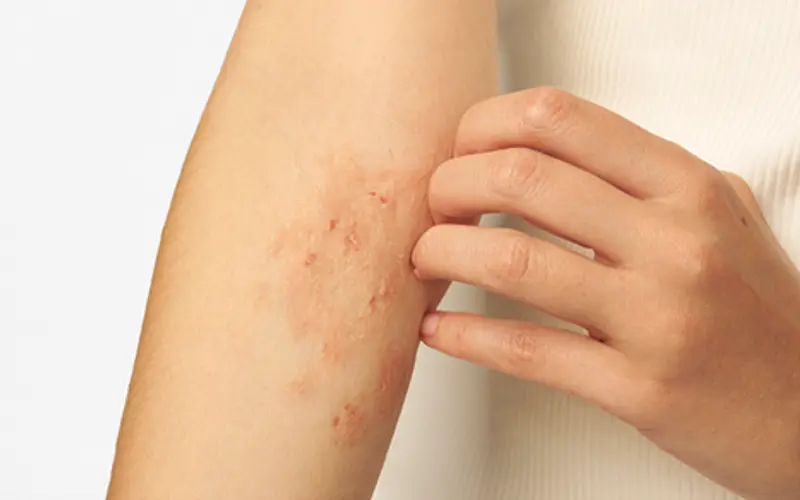 Kløende eksem på innsiden av armen