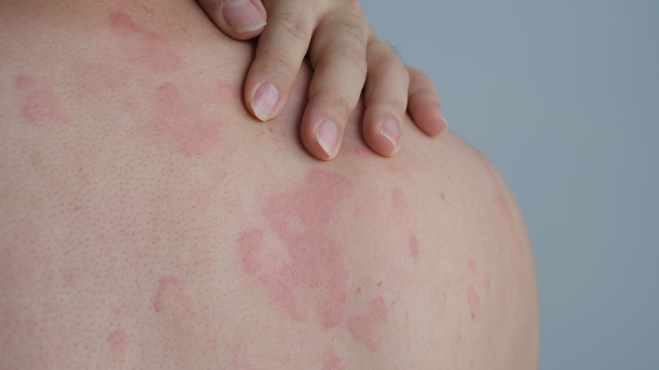 Skulder med rødt, vablete utslett