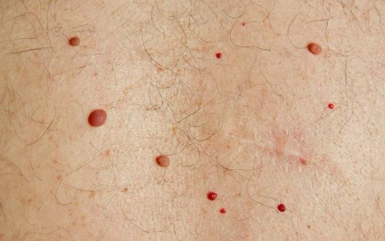 Røde prikker på huden Røde prikker på huden