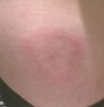 Erytema migrans på albue