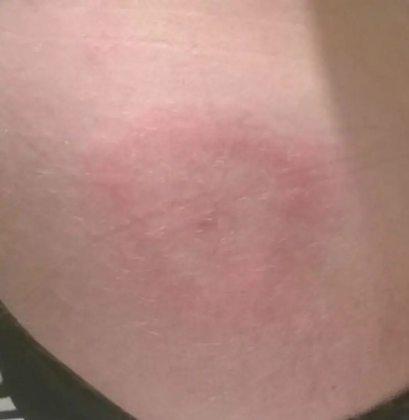 Erytema migrans på albue