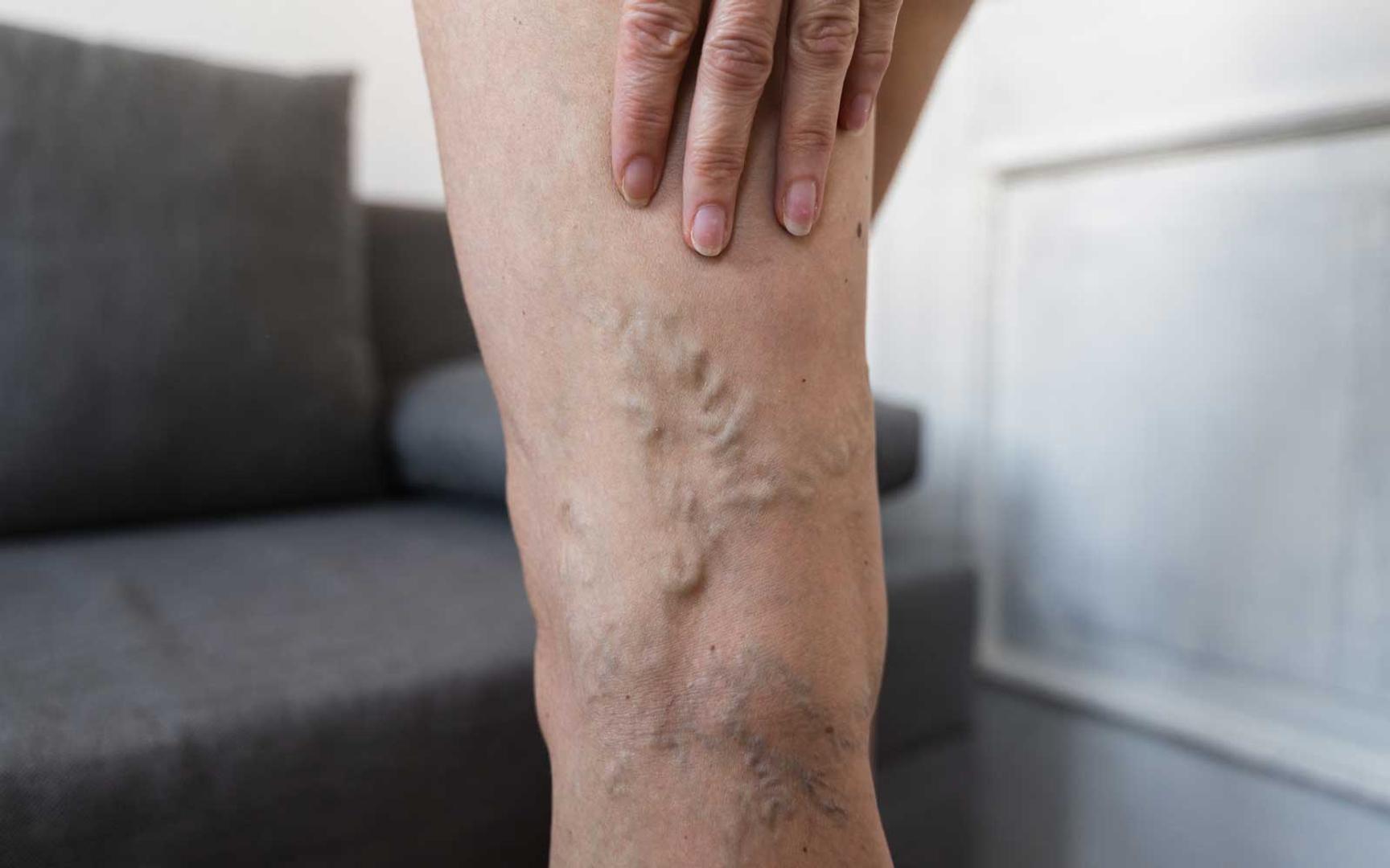 Åreknute buler gjennom huden på baksiden av kneet og oppover låret.