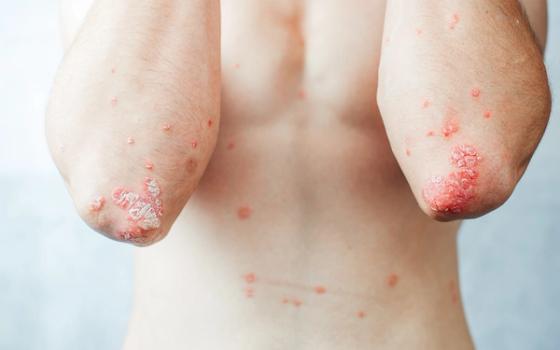 Er huden eller hodebunnen din plaget av psoriasis? Er huden eller hodebunnen din plaget av psoriasis?