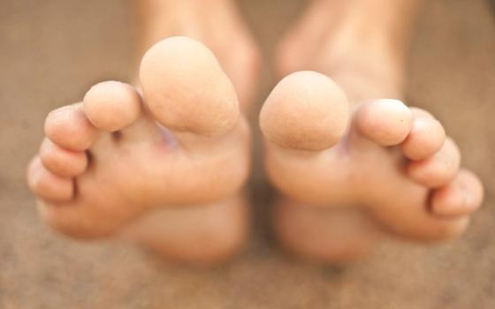 Urinsyregikt Urinsyregikt