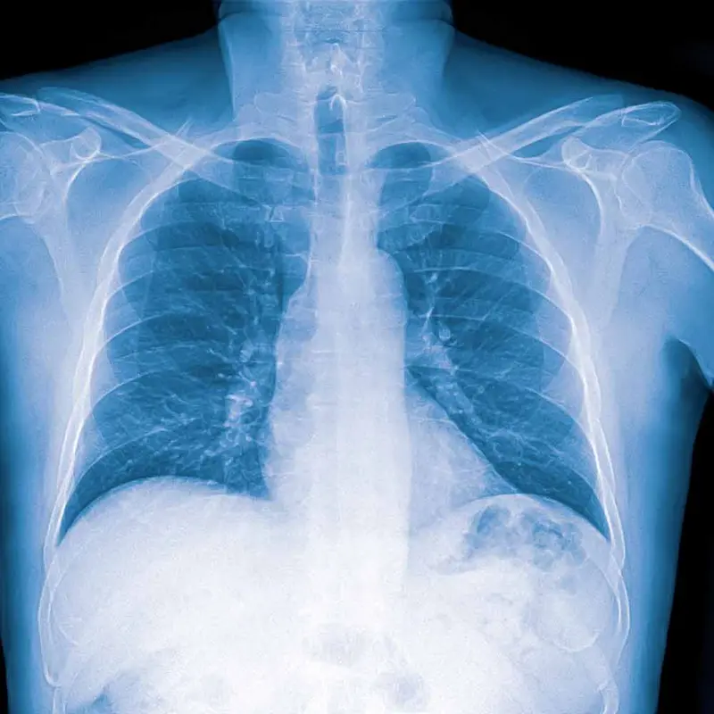 Røntgenbilde av lunger med lungebetennelse