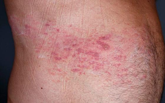 Helvetesild (herpes zoster) Helvetesild (herpes zoster)