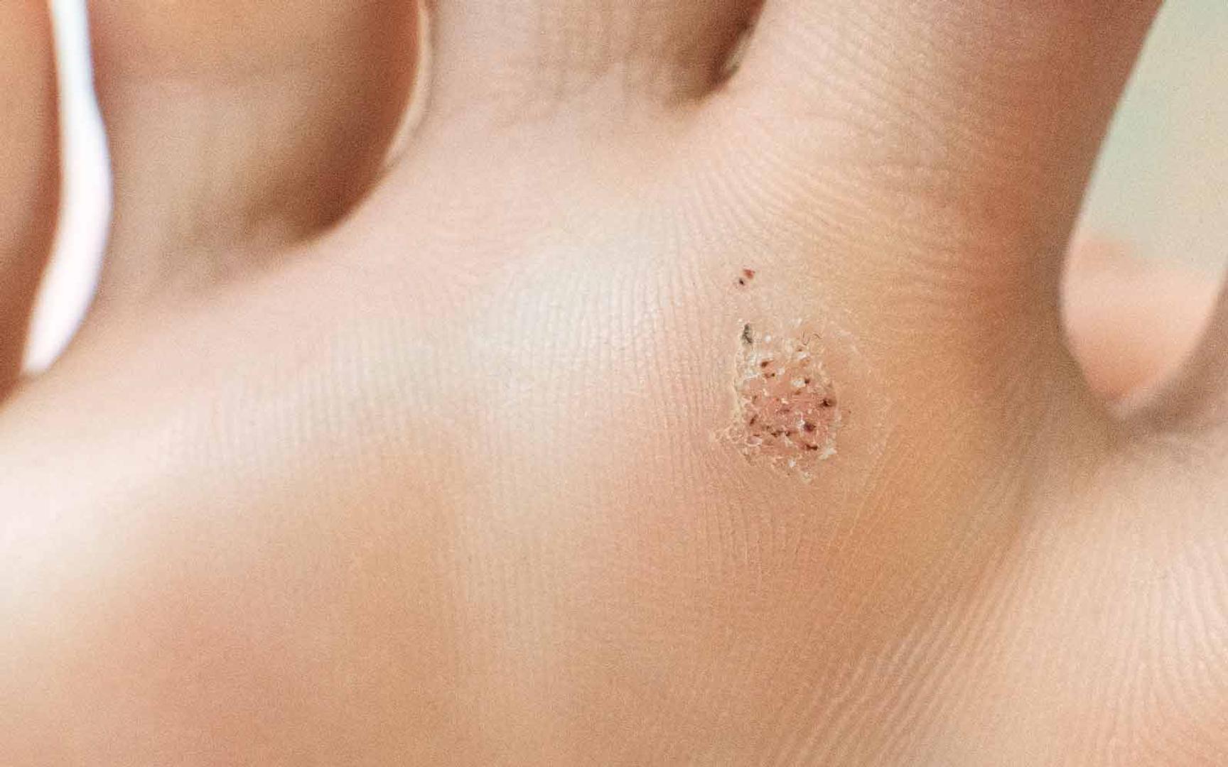 Fotvorte under fotsålen med karakteristiske svarte prikker