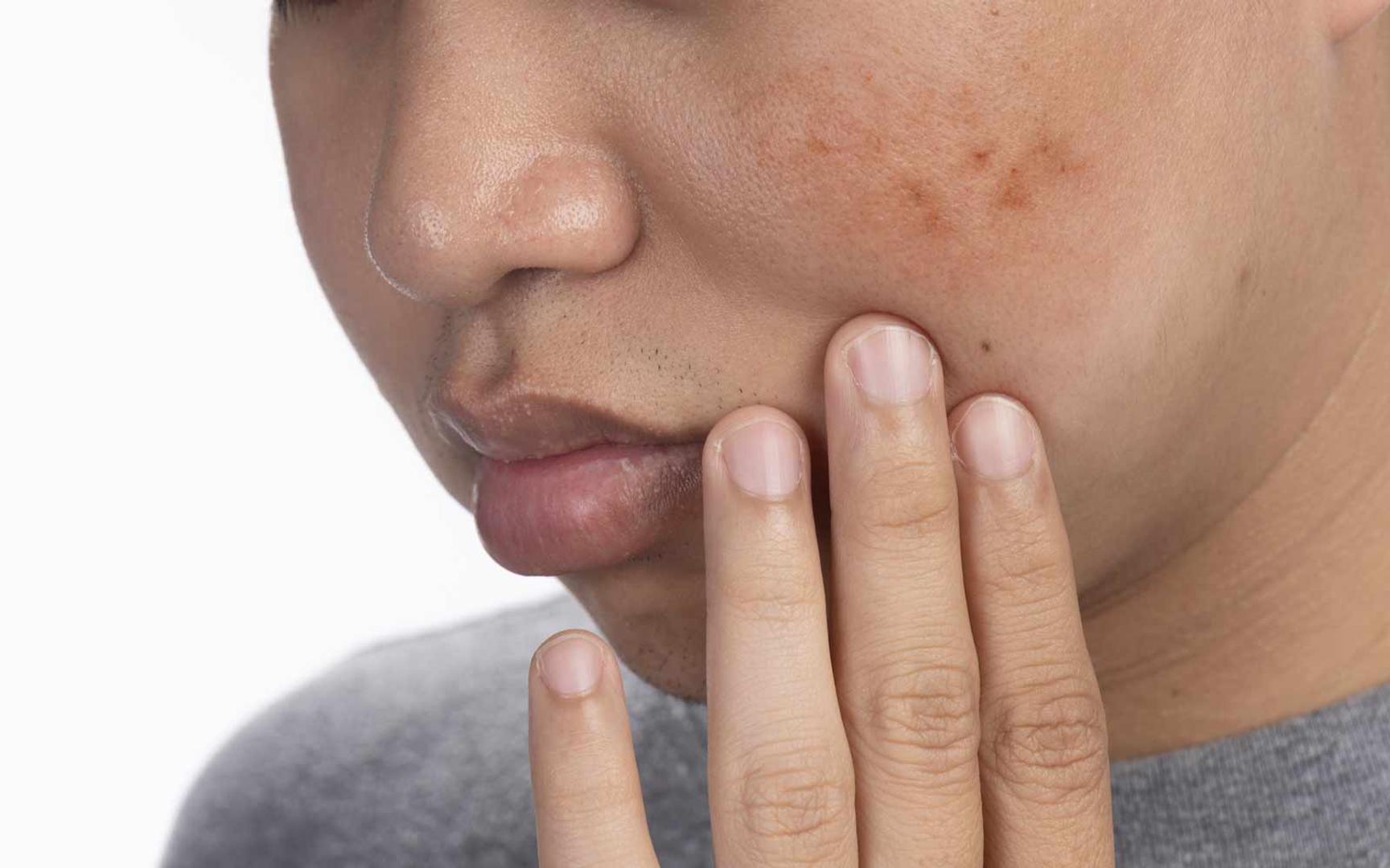 Person med pigmentflekker