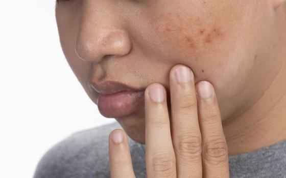 Pigmentflekker (melasma) Pigmentflekker (melasma)